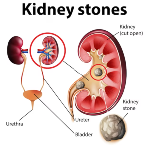 Laser Kidney Stone
