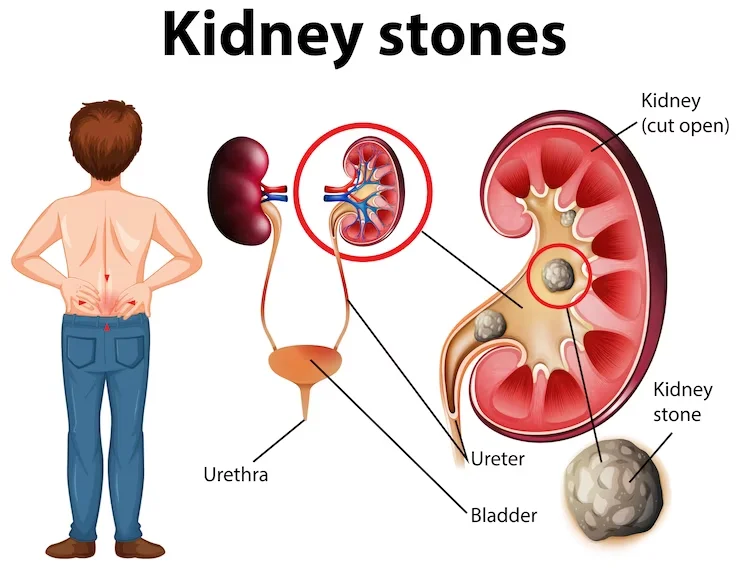Preventive Measures for Kidney Stones in Children: Tips and Guidelines