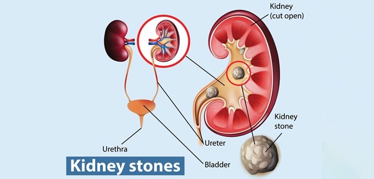 Unlocking Relief: The 5 Best Liquids for Dissolving Kidney Stones Quickly